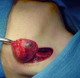 Удаление атеромы хирургическим путем: процесс операции