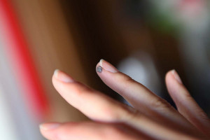 Родинки на пальцах рук: вредят ли они здоровью кожи