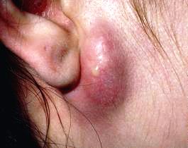 Атерома за ухом: суть возникновения и методы лечения