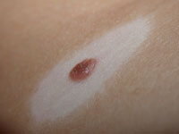 Why do I have white skin around my mole? | Zocdoc Answers