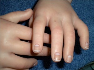 Родинки между пальцами рук: чем вредны для здоровья и как удалить